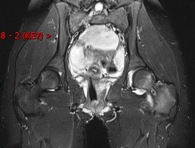 Figure 2 for case Osteoid osteoma ( RID4005 )